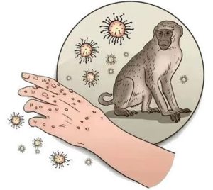 Nucleic acid extracion of Monkeypox Virus; Nucleic acid isolation of Monkeypox Virus; Nucleic acid purification of Monkeypox Virus;